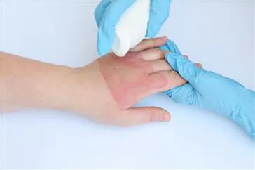  پروتکل جامع سوختگی  و نسخه دوم پروتکل تشخیصی درمانی مولتیپل اسکروزیس MS