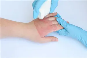  پروتکل جامع سوختگی  و نسخه دوم پروتکل تشخیصی درمانی مولتیپل اسکروزیس MS