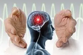 دستورالعملهای بالینی وزارت سال 1400-استاندارد خدمت برنامه‌ریزی کامل عمل جراحی فانکشنال DBS با دستگاه استریوتاکسی و تحریک الکتریکی عمقی مغز