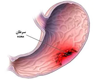 دستورالعملهای بالینی وزارت سال 1400-استاندارد مسیر بالینی تشخیص، درمان و پیگیری سرطان معده