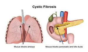 دستورالعملهای بالینی وزارت 1400- نسخه دوم پروتکل تشخیصی و درمانی بیماری سیستیک فیبروزیس (Cystic Fibrosis)