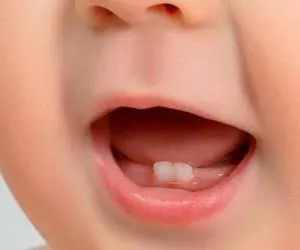 دستورالعملهای بالینی وزارت 1401- استاندارد طرح درمان جامع دندان های دائمی بیرون افتاده در اثر ضربه