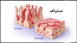 دستورالعملهای بالینی وزارت 1402- پروتکل تشخیصی درمانی بیماری سلیاک