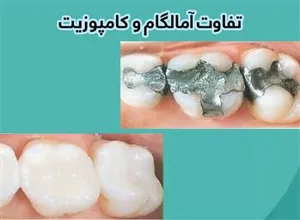 دستورالعملهای بالینی وزارت 1402- شناسنامه و استاندارد دو خدمت آمالگام و کامپوزیت رزینی