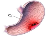 دستورالعملهای بالینی وزارت سال 1400-استاندارد مسیر بالینی تشخیص، درمان و پیگیری سرطان معده