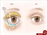 دستورالعملهای بالینی وزارت سال 1400- پروتکل تشخیصی و درمانی بیماری میاستنی گراویس (Myasthenia Gravis)