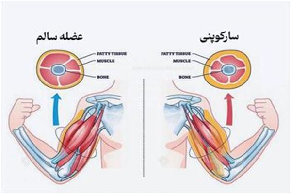 دستورالعملهای بالینی وزارت 1403- راهنمای بالینی مدیریت و درمان بیماری استئوپروز و سارکوپنی- مراکز