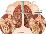 دستورالعملهای بالینی وزارت 1403- راهنمای مسیربندی بالینی COPD- مراکز