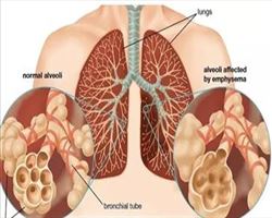 دستورالعملهای بالینی وزارت 1403- راهنمای مسیربندی بالینی COPD- مراکز