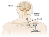 دستورالعملهای بالینی وزارت 1403- نسخه دوم شناسنامه و استاندارد خدمت Vagal Nerve Stimulation  (VNS)